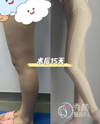 昆明十大正规吸脂医院排