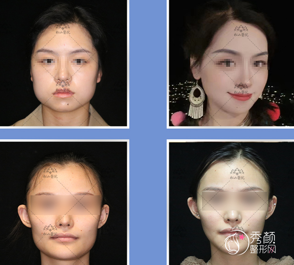 重庆松山医院朱乐林磨骨技术怎么样？附下颌角磨骨案例两则