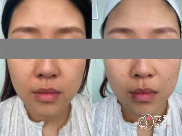 浙江大学邵逸夫医院皮肤科做超声炮怎么样？多少钱？附超声炮案例对比