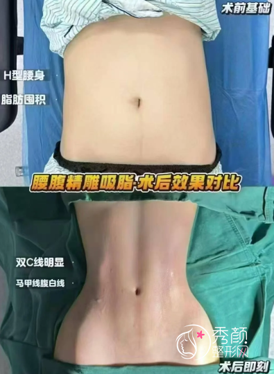 郑州吸脂医生排名前十名曝光：罗明生|陈三群|杨国宝|孟宝玺等医生上榜