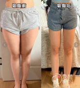 北京吸脂哪家医院好？北