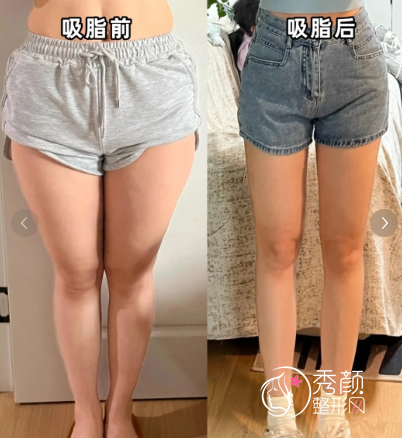 北京吸脂哪家医院好？北京正规吸脂医院+口碑医生介绍