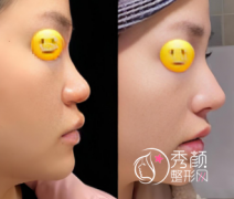 国内隆鼻技术好的医生：