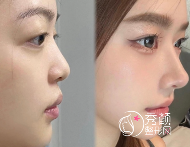 北京鼻修复哪个医生好？任影、刘彦军、王军、李劲良等医生隆鼻技术好！