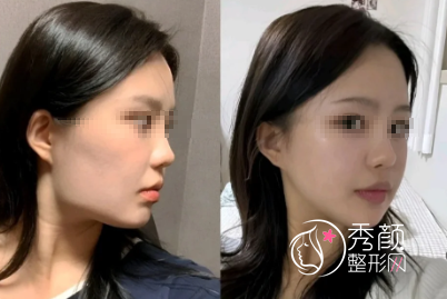 北京磨骨手术哪家医院好？北京磨骨口碑医院+医生介绍