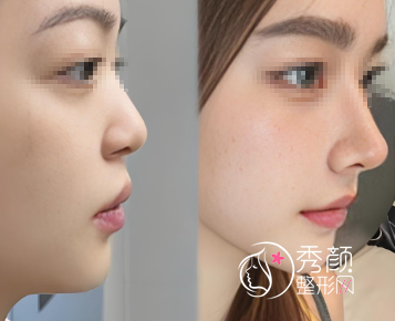 合肥隆鼻哪家医院好？合肥正规隆鼻医院+口碑医生介绍