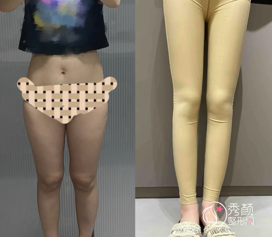 上海抽脂哪个医生好？曹卫刚|何斌|刘李娜|张怀军等都是上海抽脂比较出名的医生