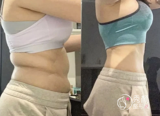 南京吸脂哪个医院好？南京美好尉来|嘉怡美|美贝尔等医院技术好！