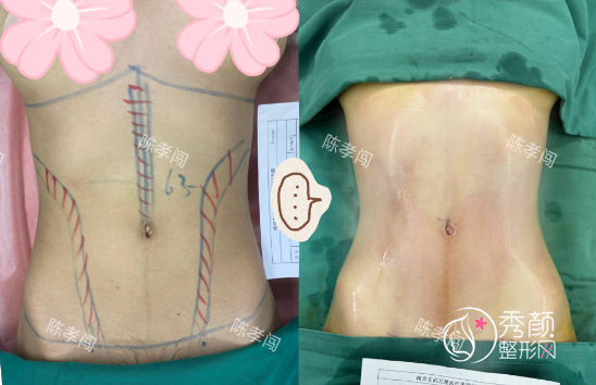 南京陈孝闯吸脂怎么样，单部位吸脂8800元起！附腰腹吸脂案例