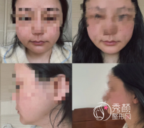 南京吸脂专家哪个好？南