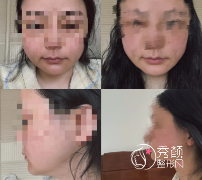 南京吸脂专家哪个好？南京十大吸脂医生排名曝光