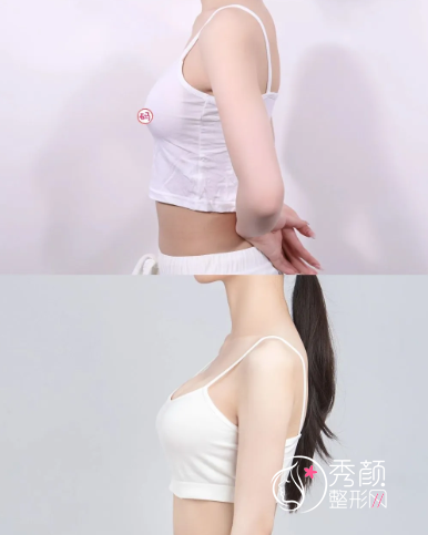 杭州隆胸哪个医生好？栗勇|程琳|黄良飞|郑翔宇|黄剑媚等都是大热门