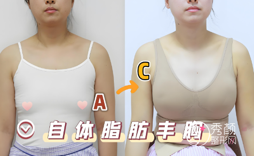 福州隆胸哪家医院做的比较好？协和|省立|海峡|格莱美|伽禾伽美等医院