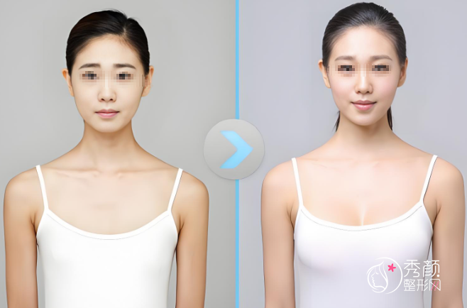 厦门隆胸哪家医院做的比较好？厦门欧菲|华美|薇格|修志夫等医院