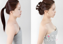 天津隆胸整形医院哪家好