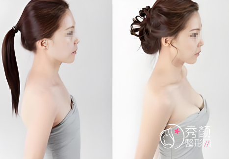 天津隆胸整形医院哪家好？天津美莱|天津伊美尔|天津博莱美等医院