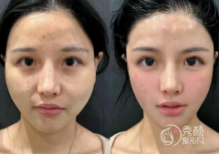 脂肪填充哪个医院全国做