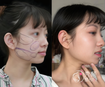 长春吸脂手术正规医院哪