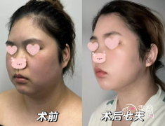 兰州吸脂哪家医院好？兰