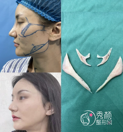 全国前十名的磨骨整形专家：李运峰|何照华|吴国平|朴兴植等医生