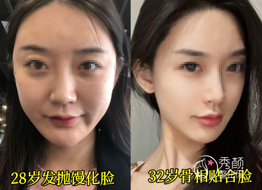 上海馒化脸修复哪家医院好？上海仁爱|沪中|伯思立|时光等医院