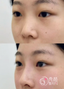 北京再生材料填充哪家医