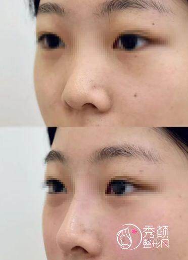 北京再生材料填充哪家医院好？北京画美|薇琳|漾格|美莱等医院