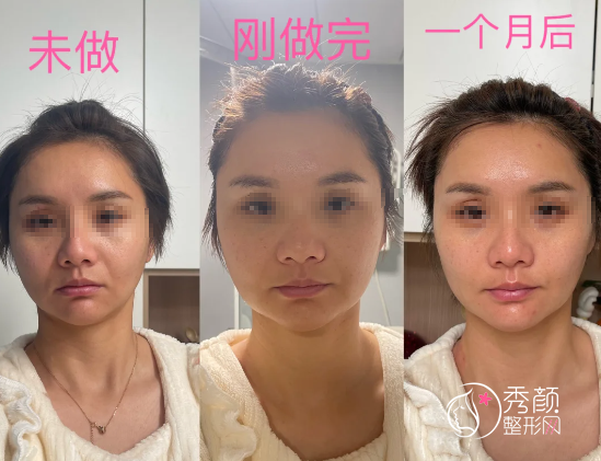 超声炮不是万能紧肤神器，真被打毁脸的人，十个有九个都是自己瞎搞的