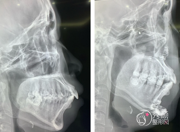 正颌手术医保可以报销吗？正颌手术一般费用是多少钱？