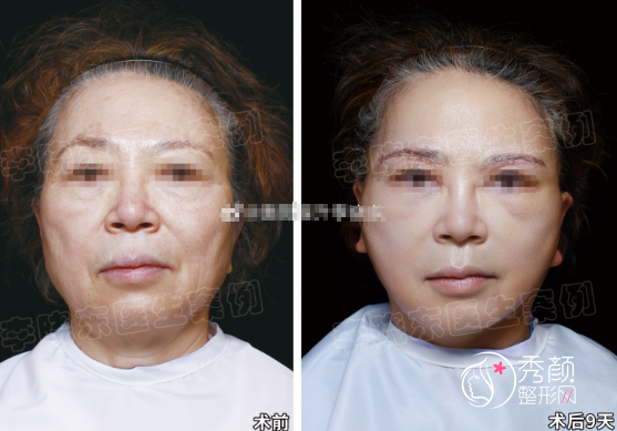 北京拉皮手术哪个医生好？黄寅守、李晓东、杜太超等技术亮点+案例分析