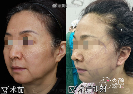 北京拉皮手术哪个医生好？黄寅守、李晓东、杜太超等技术亮点+案例分析