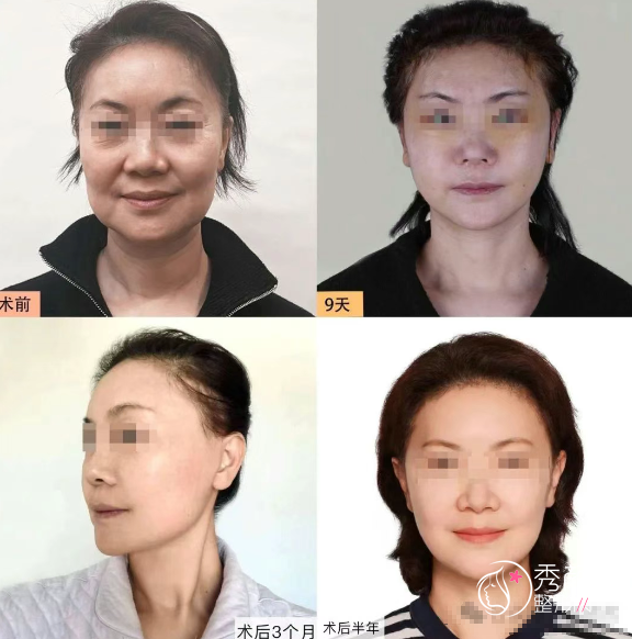 北京两大拉皮名医对比：袁强的MCR复合拉皮vs杨俊的DGS四维青春复原术