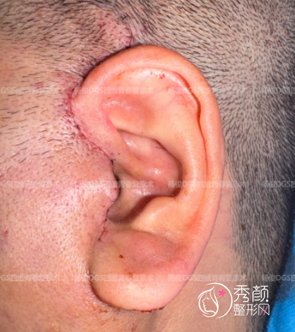 北京两大拉皮名医对比：袁强的MCR复合拉皮vs杨俊的DGS四维青春复原术