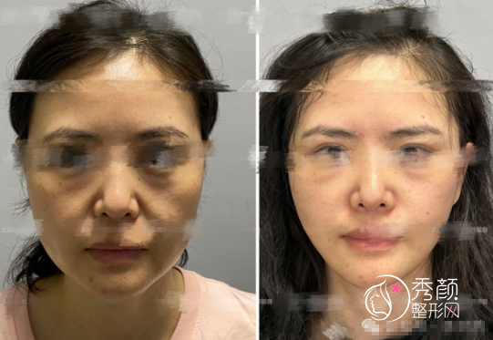 北京两大拉皮名医对比：袁强的MCR复合拉皮vs杨俊的DGS四维青春复原术