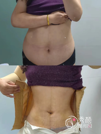 广东吸脂手术哪家医院好？美莱、军美、曙光等正规医院实力口碑测评