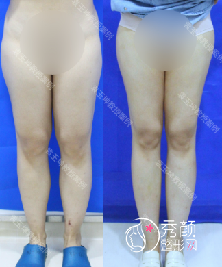 袁玉坤医生做吸脂怎么样？吸脂5600元起，附大腿环吸+手臂环吸案例