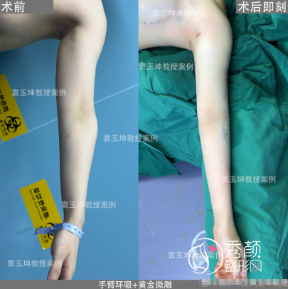 袁玉坤医生做吸脂怎么样？吸脂5600元起，附大腿环吸+手臂环吸案例