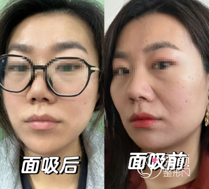 国内面部吸脂好的医生：张超、蒲小兵、刘李娜、曹孟君等医生技术鲜明