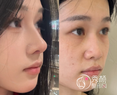 西安隆鼻哪个医生做得好？曾熬|王俊河|黄舟|张沙沙等医生测评