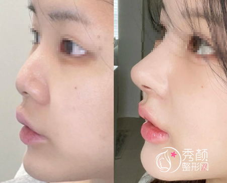 上海鼻子整形医生排名：戴传昌|沈国雄鼻修复技术好，范荣杰初鼻效果好