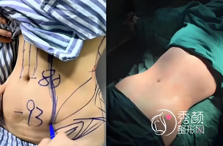 全国排名前十的三甲吸脂医院：北京协和医院|上海九院|杭州邵逸夫医院等