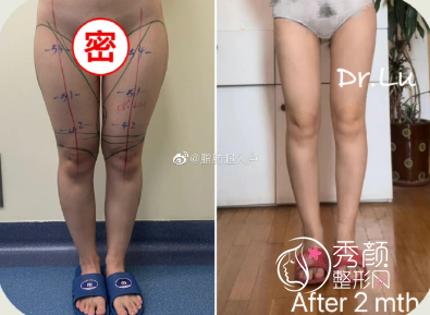 卢新蕾吸脂怎么样？从大腿吸脂案例案例来看吸脂效果好！