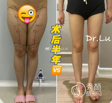 卢新蕾吸脂怎么样？从大腿吸脂案例案例来看吸脂效果好！