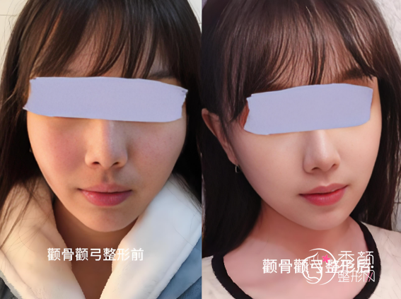 关于颧骨内推的大实话，能劝一个是一个！！！