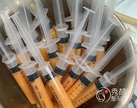 北京脂肪填充|吸脂哪个医生技术好？冯斌|任学会|王明利|乔爱军|马梅生等