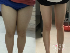 哈尔滨哪家医院吸脂手术