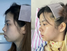 做正颌手术是选择公立医