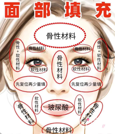 怎样打玻尿酸不馒化？这几点一定要牢记！