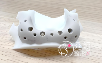 骨性填充材料：爱贝芙、宝尼达、伊妍仕少女、peek人工骨优缺点介绍