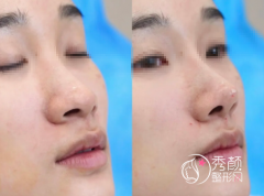 广州隆鼻哪个医院好？广